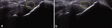 Ultrasound Guided Percutaneous Needle Tenotomy For Tendinosis Indian