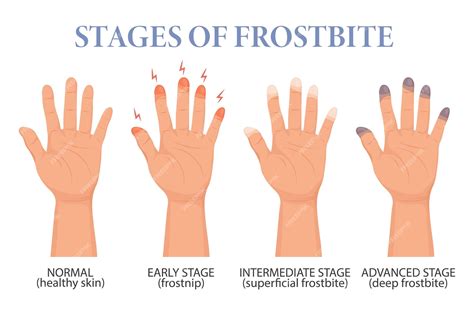 Frostbite Hands