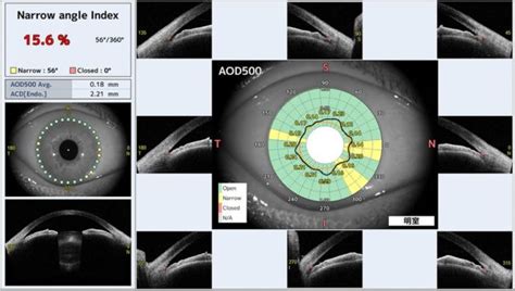 前眼部OCT CASIA2を導入しました福岡市の眼科白内障網膜硝子体手術緑内障手術望月眼科