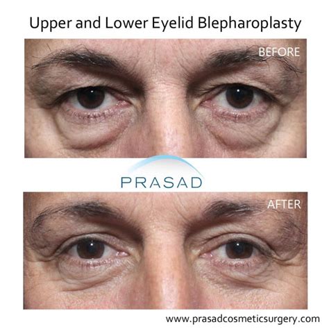 Can Upper Blepharoplasty Go Wrong Dr Prasad Blog