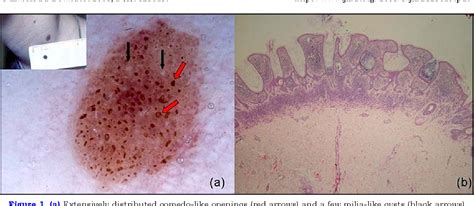 Congenital Melanocytic Nevus Compound Type