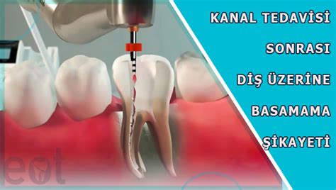 Kanal Tedavisi Sonrası Diş Üzerine Basamama Şikayeti EOT Klink