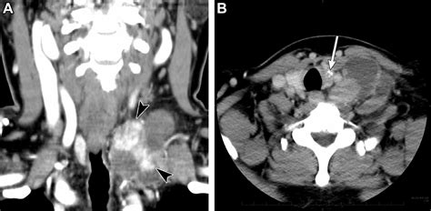 Imaging Approach For Cervical Lymph Node Metastases From Unknown