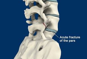 Spondylolysis Treatment Angelina County, TX | Stress Fractures ...