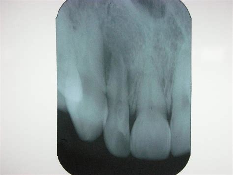 Preoperative Radiograph Of The Maxillary Left Lateral Incisor