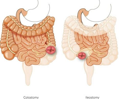 Types Of Ostomy: Colostomy, Ileostomy, And Urostomy - SIIL Ostomy 1#