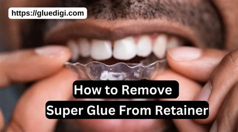 How To Remove Permanent Retainer Glue Gluedigi