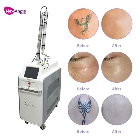 Nd Yag Laser Q Switched Pico Tattoo Removal Machine China Laser