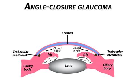 Glaucoma: Types, Symptoms & Treatment