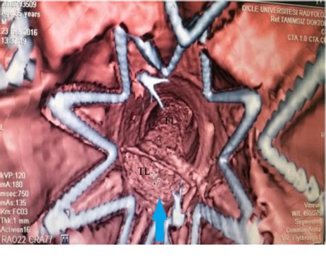 Figure 1 From Hybrid Approach To Complex Stanford Type B Dissection Unusual Extra Anatomical