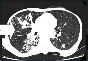 CT scan of mass in infra temporal fossa. | Download Scientific Diagram