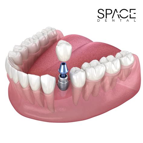 Single Dental Implants | Space Dental