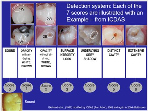 Cd Quiz 4 Histological And Clinical Features Of Caries Flashcards