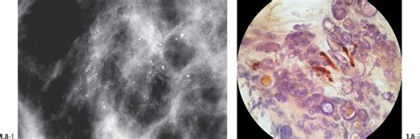 The Diagnostic Approach to Malignant Type Calcifications on the Mammogram | Radiology Key