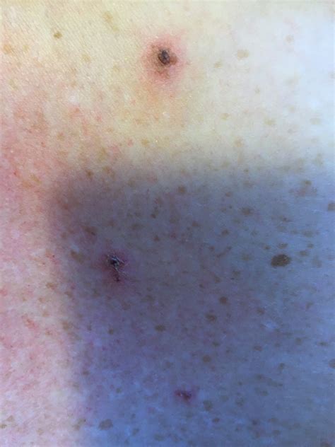 Morgellons Disease Pictures and Story | TimeSocket