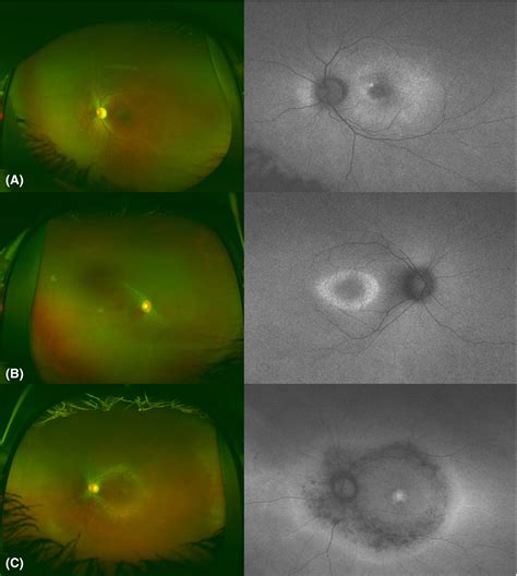 Fundus Autofluorescence Imaging In Hereditary Retinal Diseases Pichi