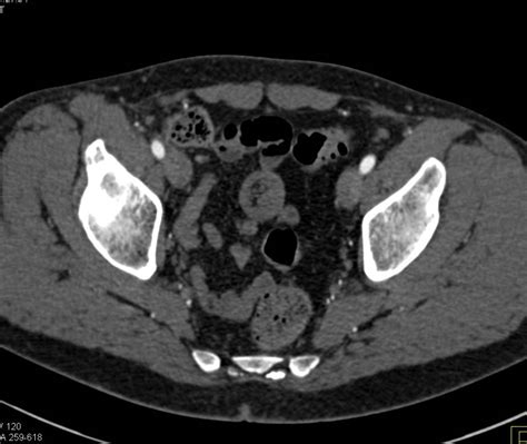 2 Cm Gist Intussusception In Ileum Small Bowel Case Studies Ctisus