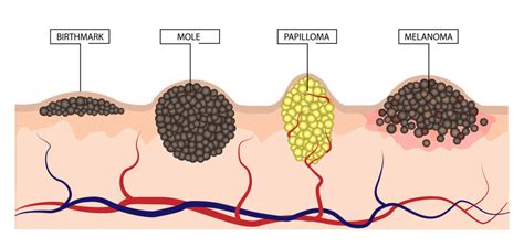 Moles - AIM at Melanoma Foundation