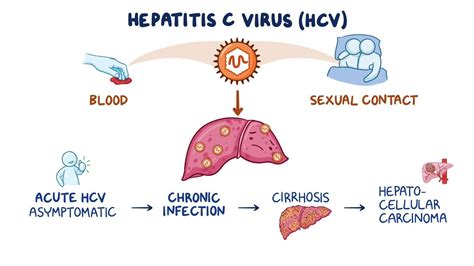 Hepatitis C Video And Meaning Osmosis