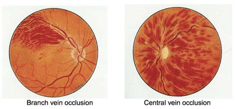 Retinal Vein Occlusion Sunshine Eye Surgeons