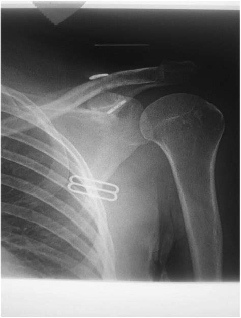 Post-operative x-ray shows over reduction of the (AC) joint. | Download ...