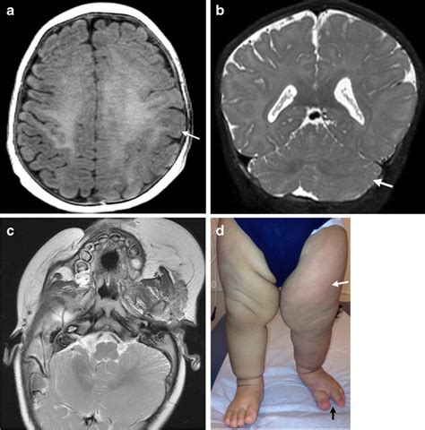 Neuroimaging Features Of Genetic Syndromes Associated With Cns Overgrowth Abstract Europe Pmc