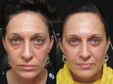 Lower Blepharoplasty Before And After