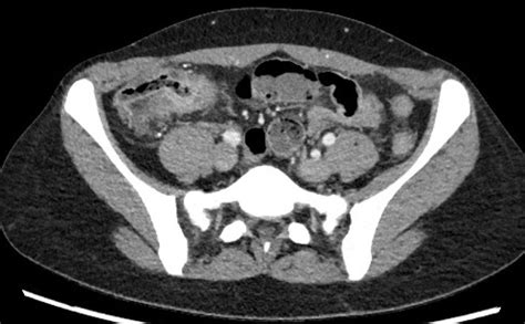 Figure Crohn Disease On Computed Tomography Contributed By Steve