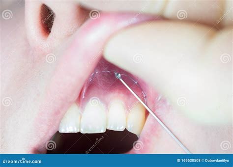 Anestesia Dental En La Silla Del Dentista Aguja De La Jeringa Dental