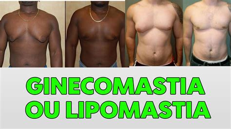 Ginecomastia Ou Lipomastia Youtube