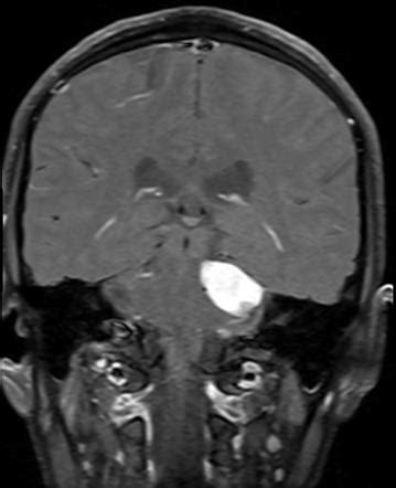 Trigeminal Schwannoma Recurrent Residual Image Radiopaedia Org