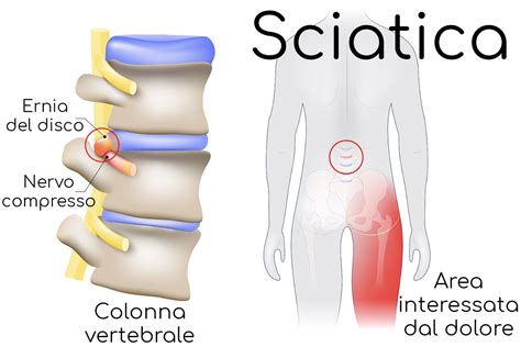 Sciatalgia Sciatica Come Curare L’infiammazione Al Nervo Sciatico Cgf Cesano