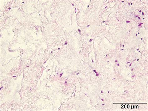 Pathophysiological Findings Of Stained Specimen Hematoxylin And Eosin