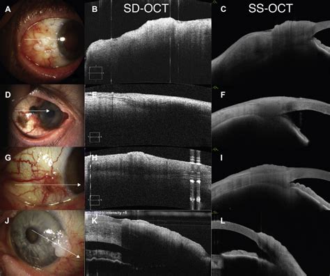 Swept Source And Spectral Domain Oct Imaging Of Conjunctival Tumors