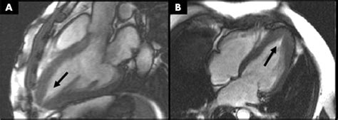 Apical Hypertrophic Cardiomyopathy Symptoms