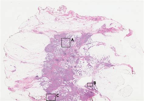 Fixed Hande Stained Pathology Of Excised Tissue From Breast Surgery