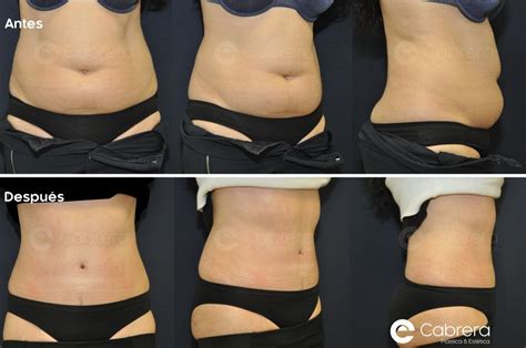 Antes Y Despu S En Abdominoplastia Dr Emilio Cabrera