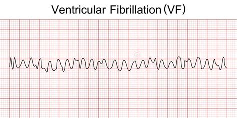 Modelo De Vf Fibrilación Ventricular De Demostración Del