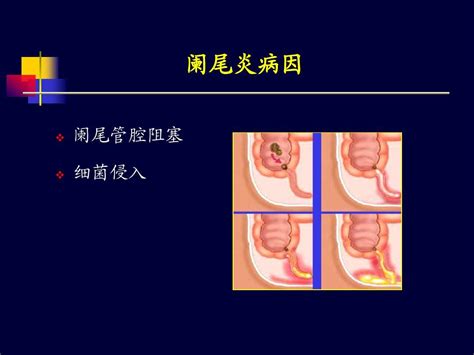 阑尾炎超声诊断word文档在线阅读与下载无忧文档