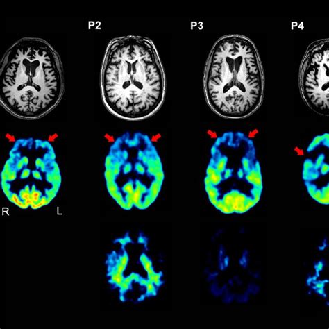 Brain Magnetic Resonance Mr Ffdg Pet And Cpib Pet Images Of