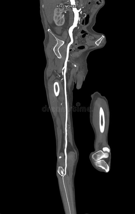 Cta Femoral Artery Run Off Mpr Curve Showing Right Femoral Artery For