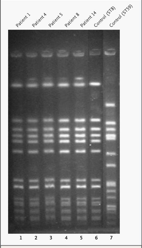 Pulsed Field Gel Electrophoresis Of Smaidigested Dna From Mrsa