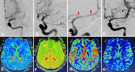 Same Patient As In Fig 2 Endovascular Recanalization And Magnetic