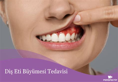 Diş Eti Büyümesi Tedavisi Perspektif Ağız ve Diş Sağlığı Polikliniği