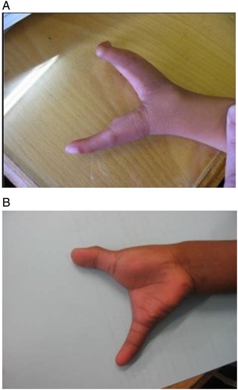 First Trimester Diagnosis Of Isolated Familial Ectrodactyly Harland