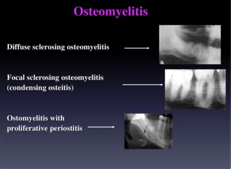 Focal Sclerosing Osteomyelitis