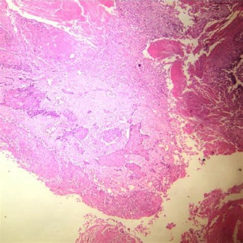 Squamous Cell Carcinoma Breast H And E X 10 The Entire Tumor Slice