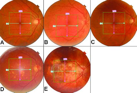 Fundus Photo Grading Examples Of Fundus Photos Grading Photos Graded