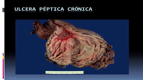 ANATOMÍA PATOLÓGICA PATOLOGÍAS GÁSTRICAS PROF DRA CARMEN COBA