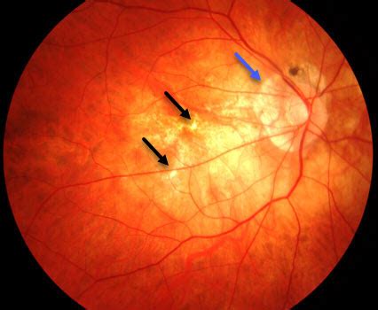 Staphyloma Retina